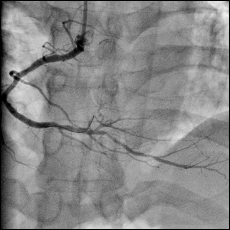 1595915842203023.jpg 1冠脈.jpg